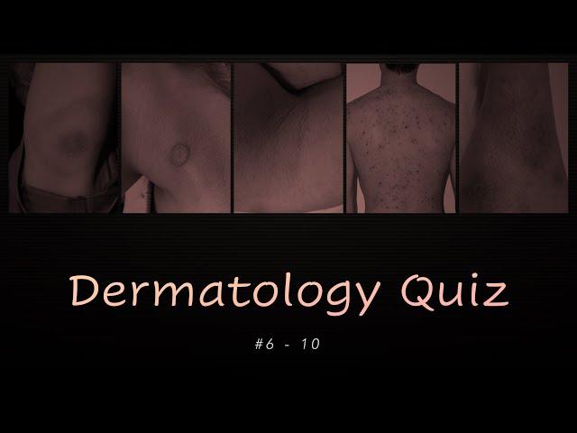 Dermatology Quiz #6 - 10