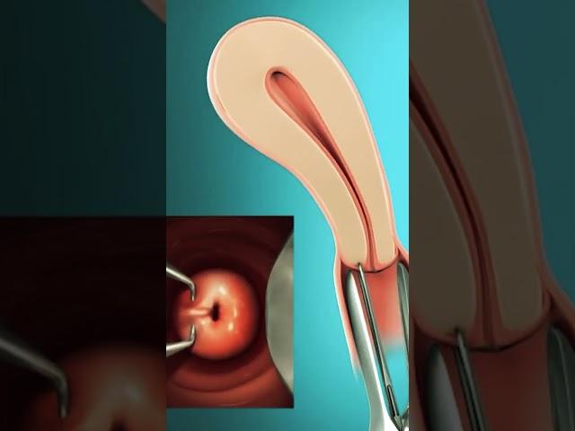 IUD insertion | How to prevent pregnancy | IUD procedure | Pregnancy kaise roke | Dr NeerajPahlajani