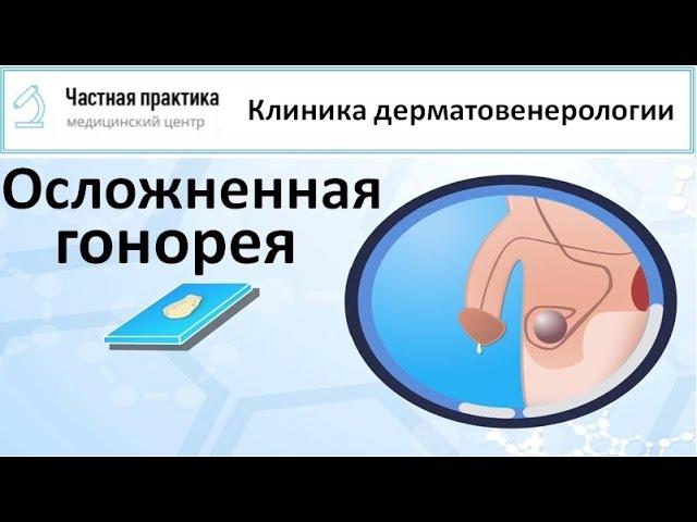 Осложненная гонорея