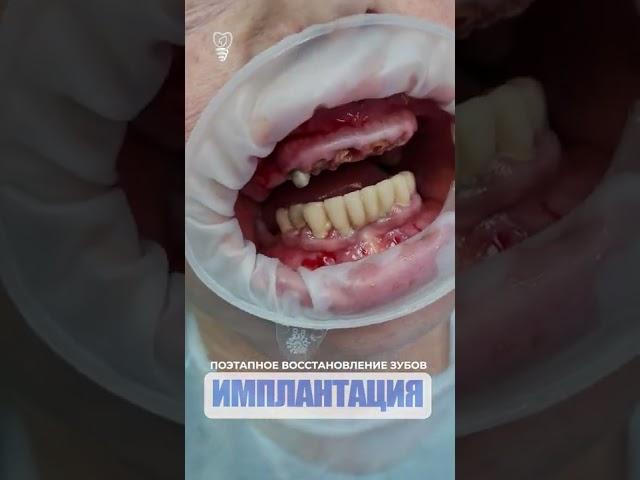 Поэтапное восстановление зубов. Step-by-step restoration of teeth.  Implantation.