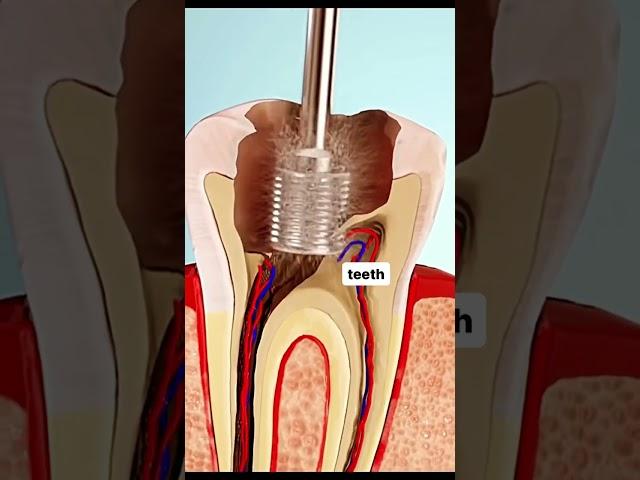 Root canal procedure|RCT technique lets watch the video|Endodontic Dentistry