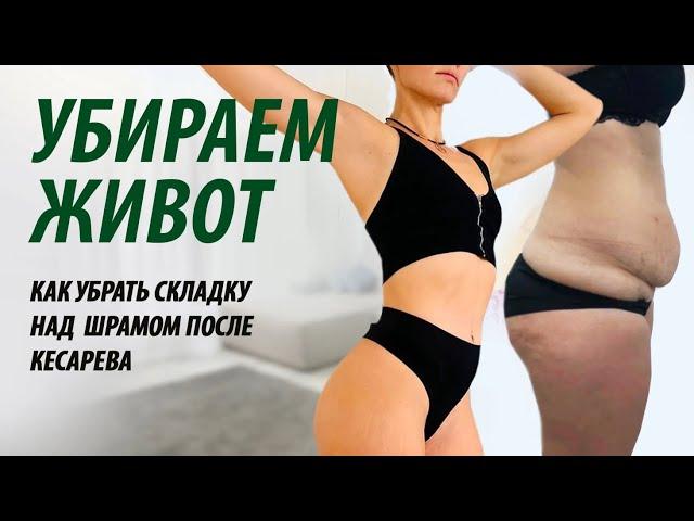 Как убрать складку на животе. Как убрать складку на животе после кесарева.Как убрать живот.