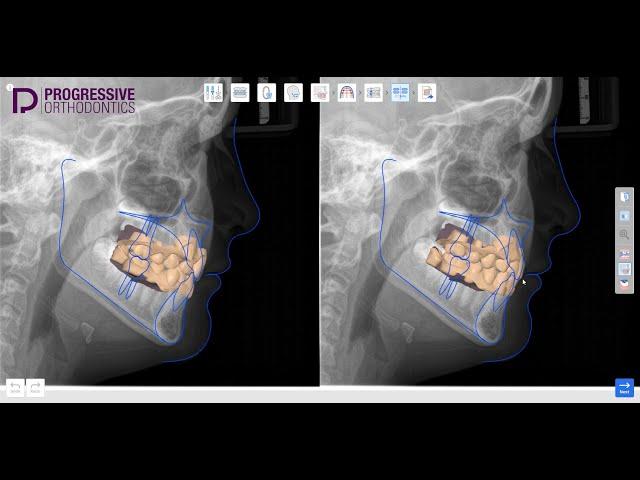 Progressive Medit Ortho Simulation App Demonstration | Feat. Dr. Collins Harrell