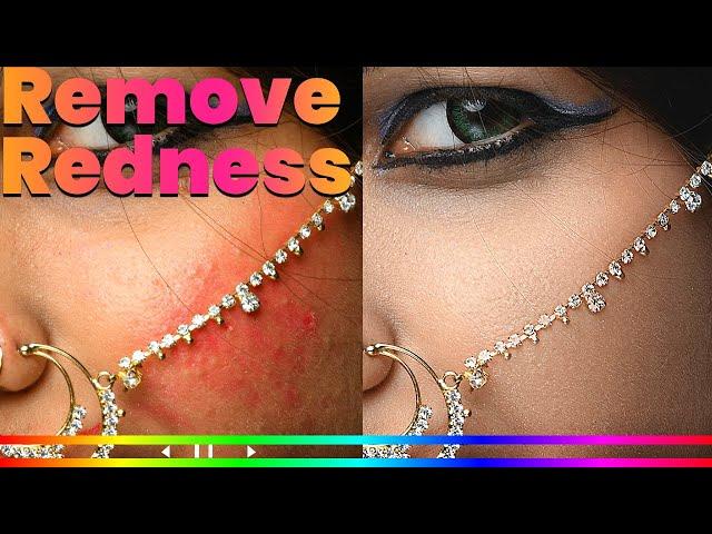 How to Remove Skin Redness - Photoshop Tutorial
