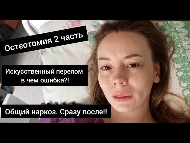 Остеотомия (искусственный перелом) для удлинения ноги. Аппарат Илизарова