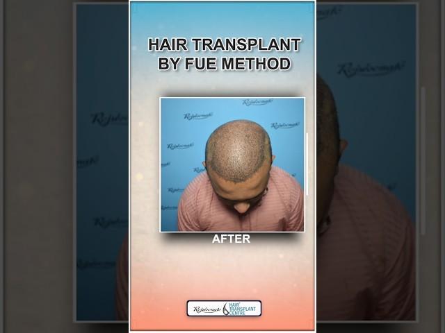 Hair Transplant By FUE Method 5051 Graft | Best hair Transplant in Indore #shorts #viral #amazing