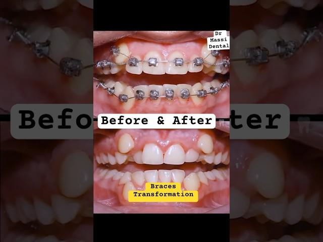 BRACES TRANSFORMATION, before and After