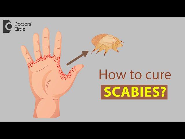 How to cure Scabies? - Dr. Rajdeep Mysore