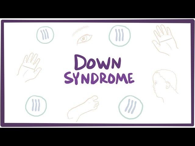 Down syndrome (Trisomy 21) - causes, symptoms, diagnosis, & pathology (Updated 2024)