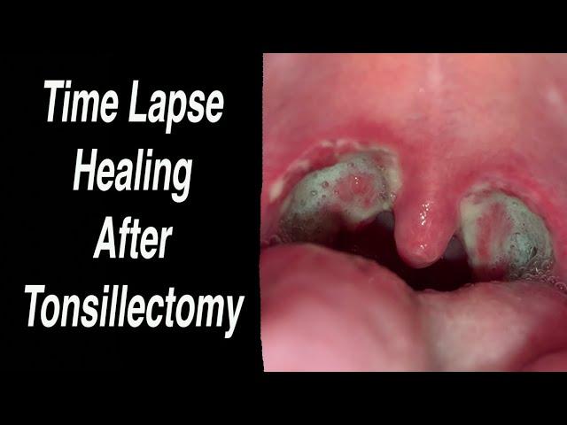 Tonsillectomy Time Lapse Healing Day by Day From Day 0 - Day 25