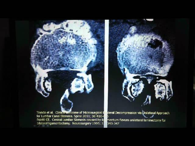 Spine Conference: Lumbar Stenosis