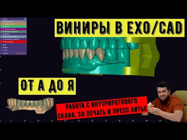 ВИНИРЫ с уровня интроорального скана - 3shape от сканирования до фиксации. Как делают виниры?