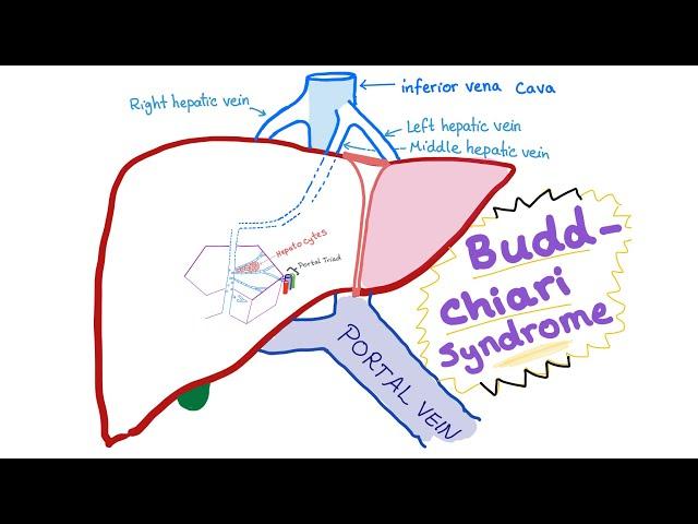 Budd-Chiari syndrome - Definition, Causes, Pathophysiology, Diagnosis & Treatment - Hepatology