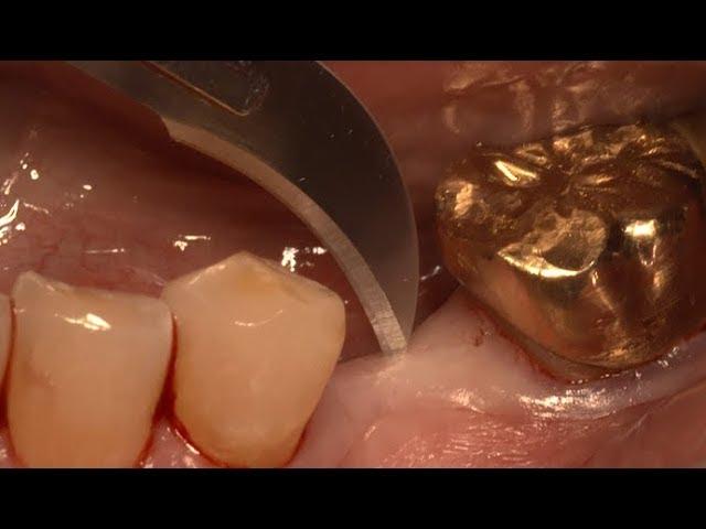 Minimally invasive implantation using New SuperLine