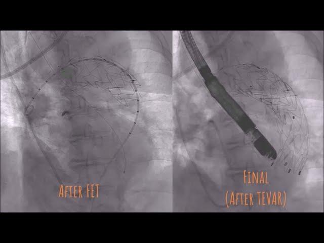 E-vita OPEN NEO total arch replacement with FET performed by Prof. Suk-Won Song and the team