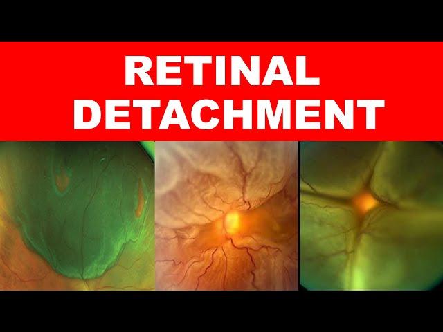 Retinal Detachment| Types, Risk Factors, Pathophysiology, Symptoms and Signs