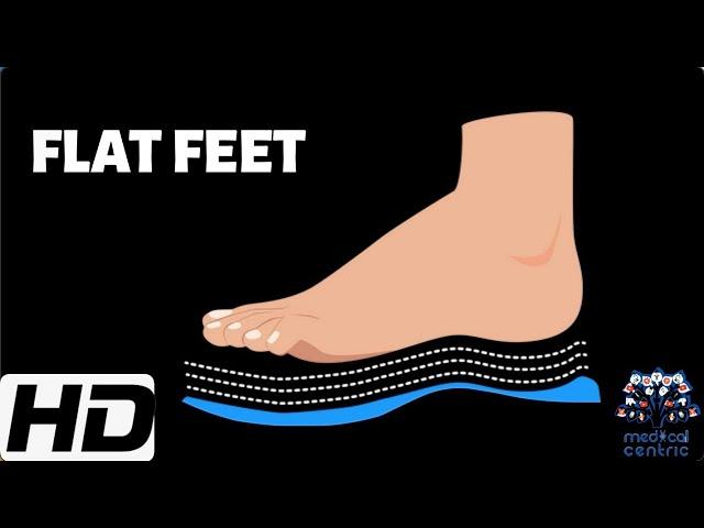 FLAT FEET: Everything You Need To Know