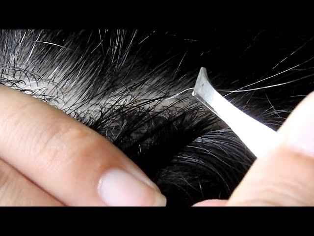 Satisfying ingrown hair - Pulling Juicy Gray Hair Part 35