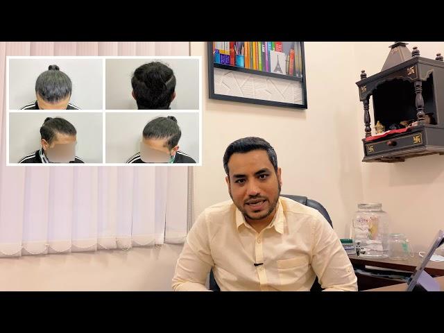 Cult Aesthetics Case Study 7: Hair Transplant By Dr. Gaurav Solanki [Call - 9990449555]