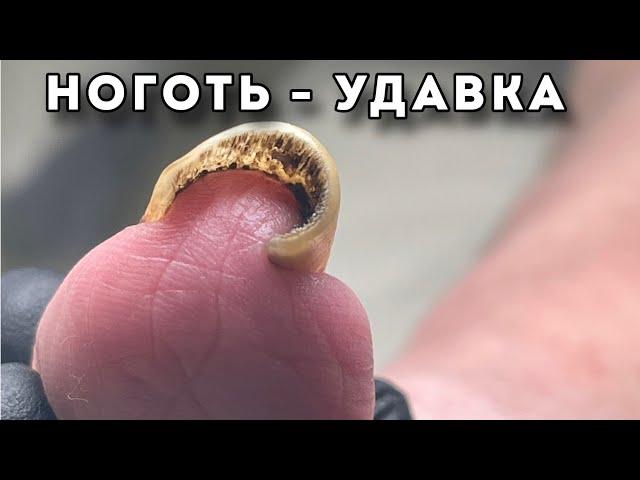 Удушающий захват ногтя для ногтевого ложе #подологтатьянапак