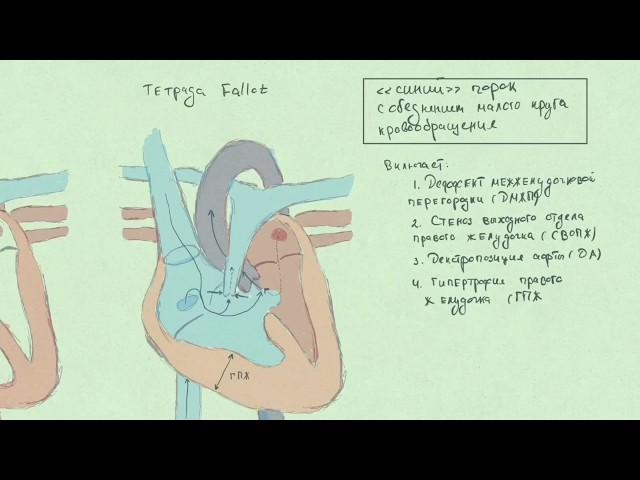 Тетрада Fallot (Фалло). Врожденные пороки сердца.