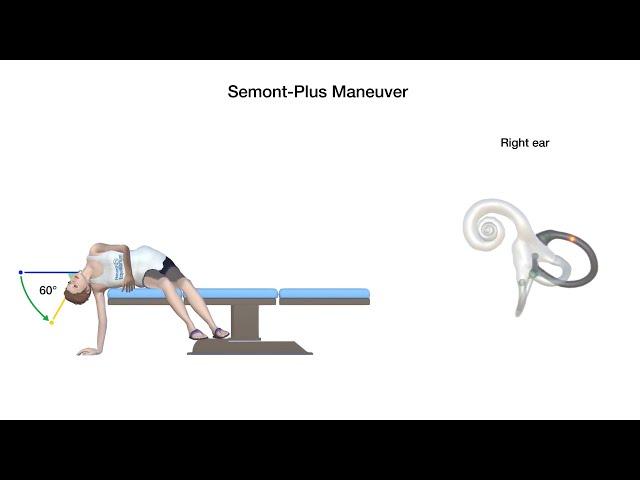 Semont-Plus Maneuver for Right Posterior Canal Benign Paroxysmal Positional Vertigo