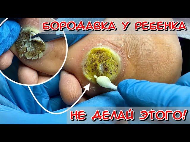 LARGE WART IN A CHILD. HOW TO REMOVE A WART? WART ON THE FOOT #alena_lavrentieva