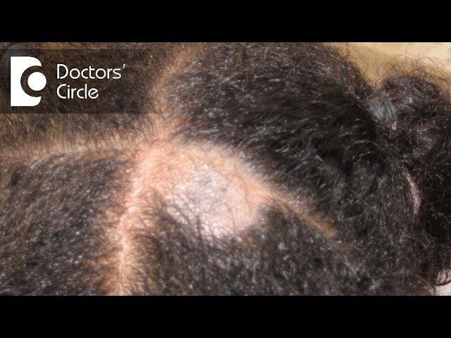 What causes Scalp Ringworm?| Effective Treatment | | Tinea Capitis - Dr. Tina Ramachander