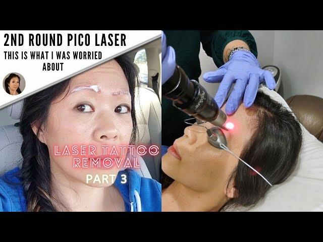 Another Microblading Removal Session: What worked and What didn't-Part 3