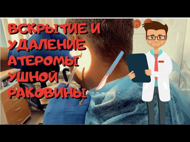 Атерома в области уха.Вскрытие и удаление атеромы ушной раковины.