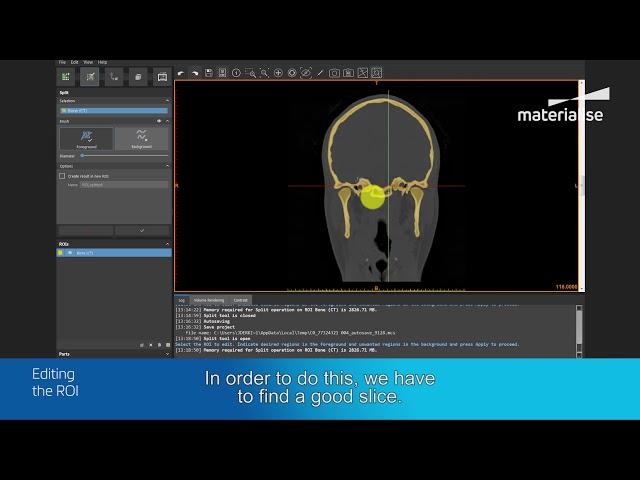 How to Create a 3D Model OF the Cranium & Mandible | Materialise Mimics inPrint Tutorial