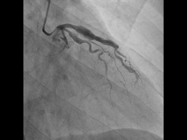 Figure 1:  Initial Left Circumflex Artery - complete occlusion with ectasia.