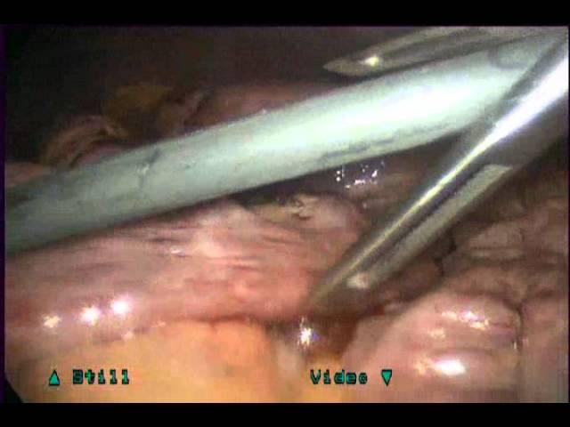 Laparoscopic Lysis Of Adhesions For Peritoneal Encapsulation