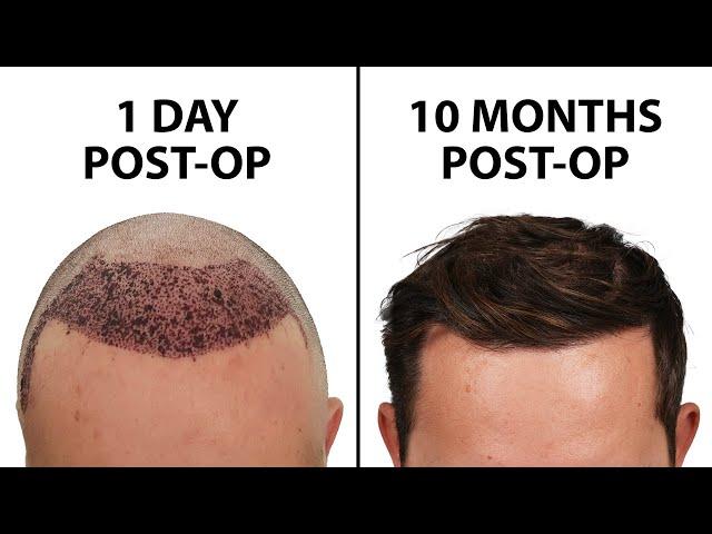 What a Hair Transplant Looks Like - Week By Week