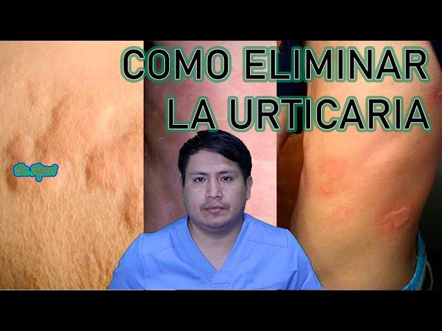 COMO ELIMINAR LA URTICARIA - RONCHAS