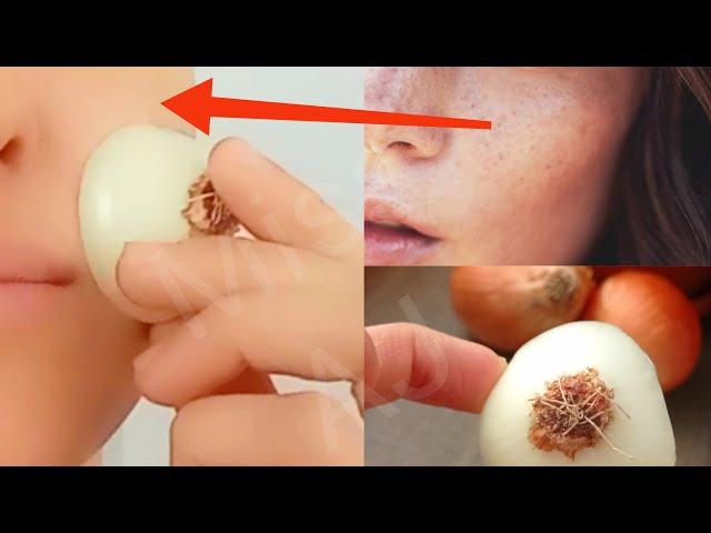 How to Get Rid of Pigmentation, Dark Spots Easily At Home