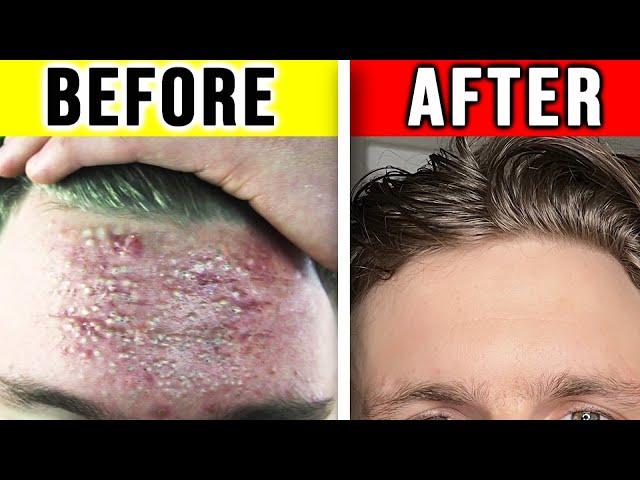 ELIMINATE BLACKHEADS & PREVENT THEM PERMANENTLY (FROM EXPERIENCE)