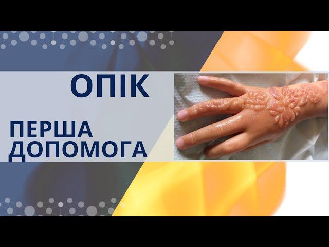 Допомога при опіках. Покази до госпіталізації