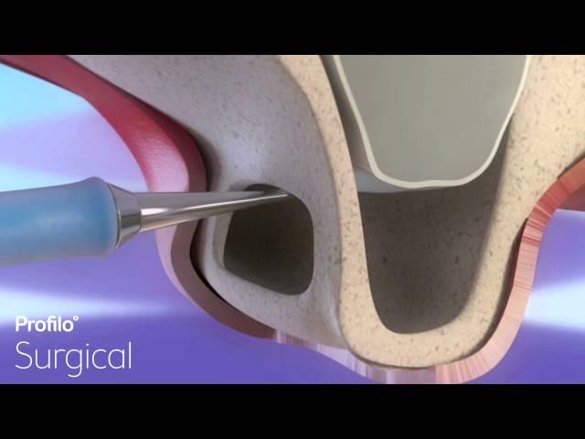 Dental Implants | Sinus Lift & Bone Graft