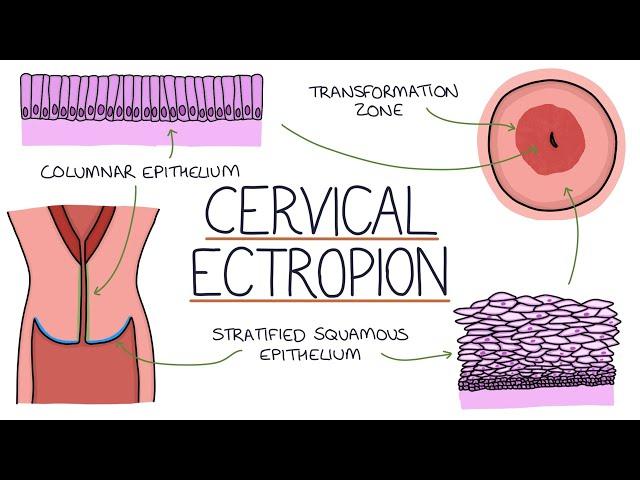 Understanding Cervical Ectropion / Cervical Erosion