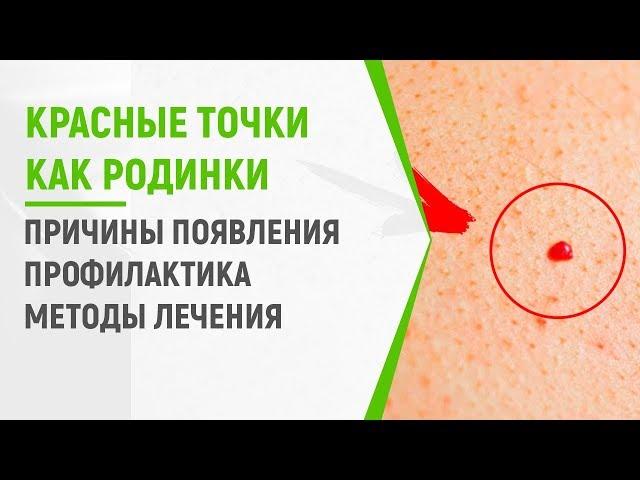 Красные точки на теле как родинки