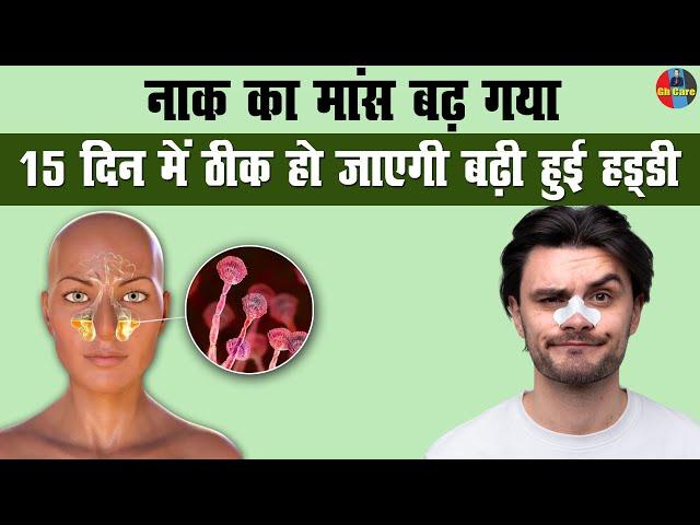 नाक का मांस बढ़ गया 15 दिन में ठीक हो जाएगी | Enlargement of nose | Sinusitis #homeremedies #tips