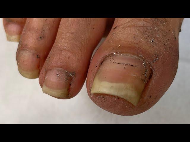 Transformação Incrível! Pedicure Extrema em Pé Negligenciado com Unhas Enormes!