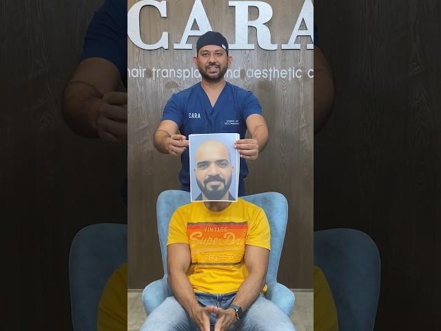 "Before and After: The Incredible Sapphire FUE Hair Transplant Journey at CARA"