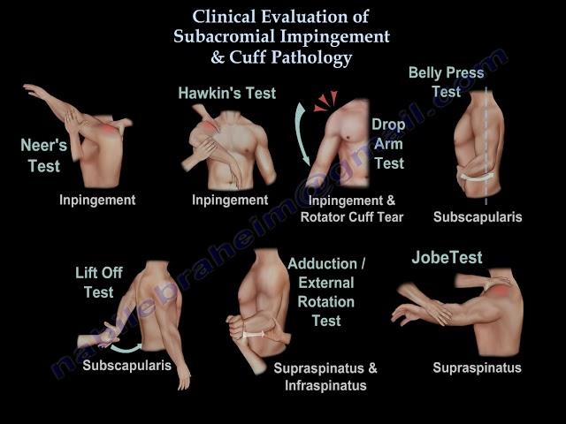 Shoulder Examination / Subacromial, Cuff - Everything You Need To Know - Dr. Nabil Ebraheim