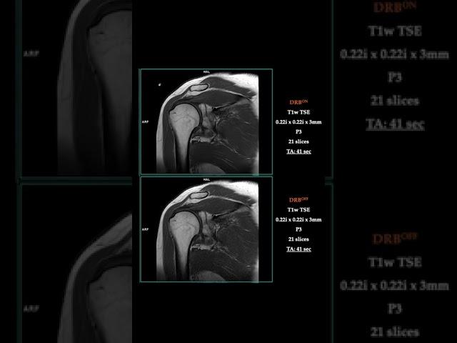 MRI – FAST SHOULDER w/DRB