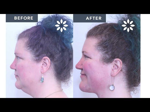 Different Types of Neck Lift - Part 1 | 8 West Clinic - Vancouver, BC