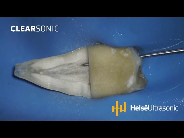 51 ClearSonic   Helse Ultrasonic