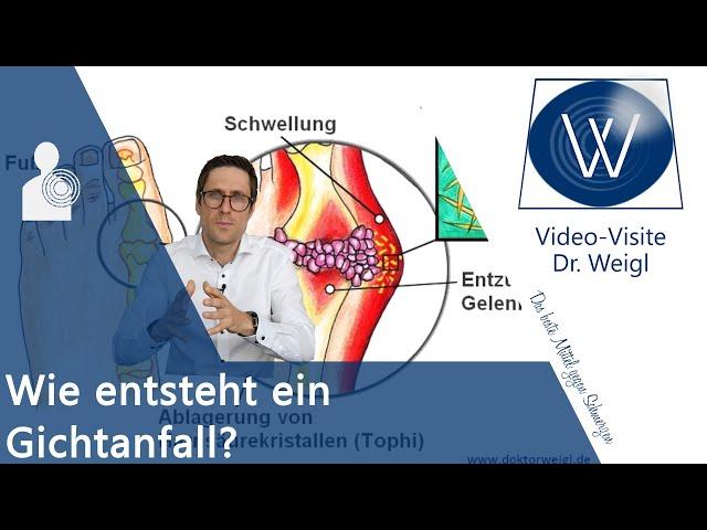 Gicht  Oft unterschätzt aber sehr schmerzhaft: Akuter Gichtanfall - Ursachen, Symptome & Therapie