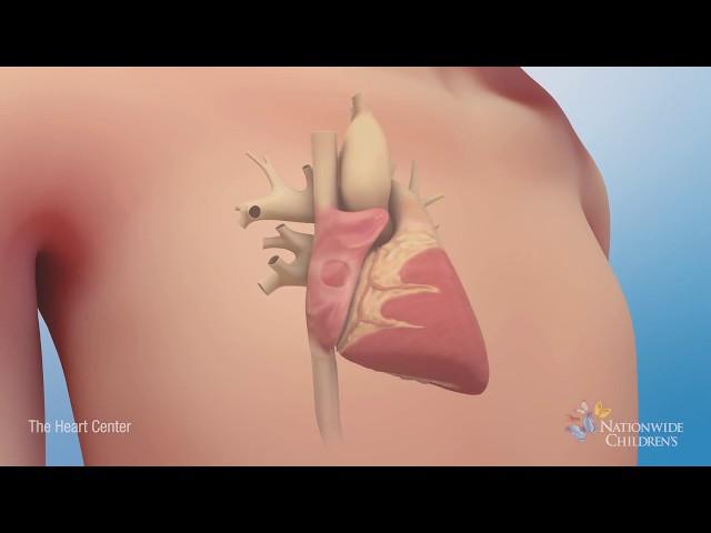 Understanding Atrial Septal Defect (ASD)